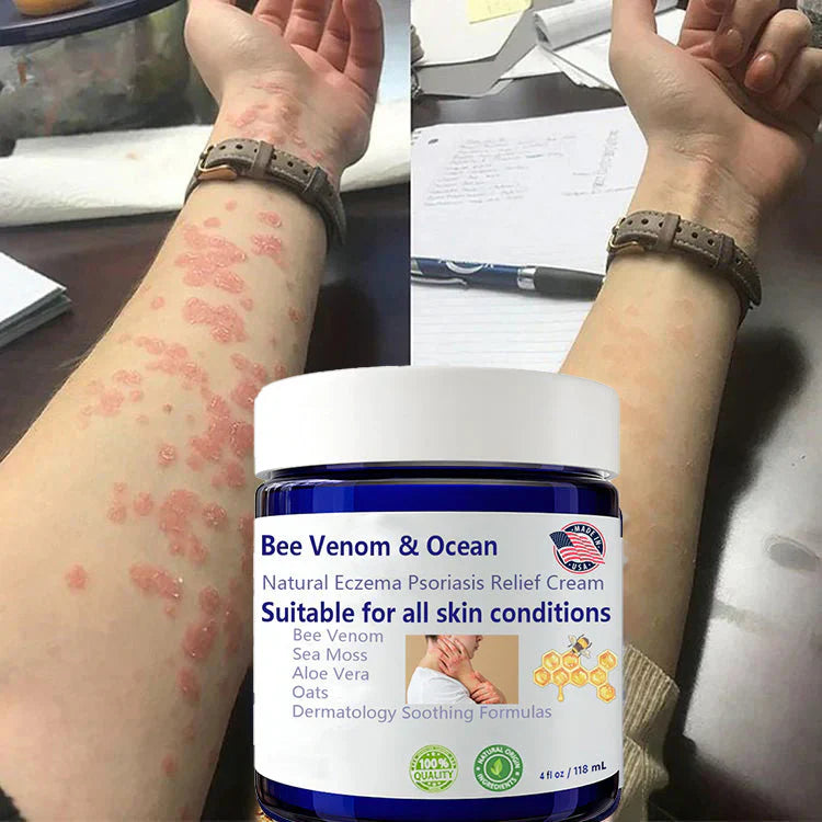 SwasthSkin™ - Bee Venom & Ocean Natural Eczema Psoriasis Relief Cream 🐝🌊 (Buy 1 Get 1 Free🔥)